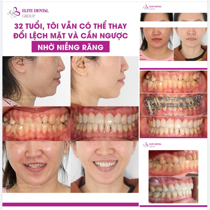 "Răng của mình lệch lạc, móm, mặt thì lệch lệch làm cho mình rất ngại và không tự tin gặp nói chuyện với người khác.