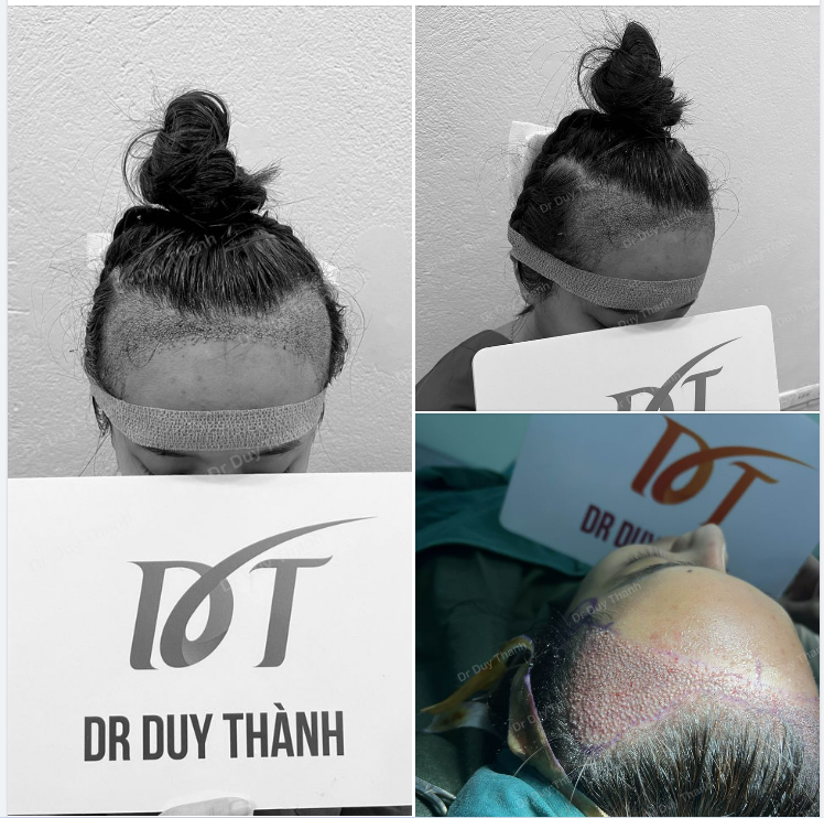 KẾT QUẢ NGAY SAU CẤY 1625 NANG TÓC KHÁCH NỮ HÀ NỘI