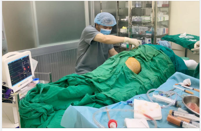 Cấy mỡ làm đầy hõm mông với Dr Vương