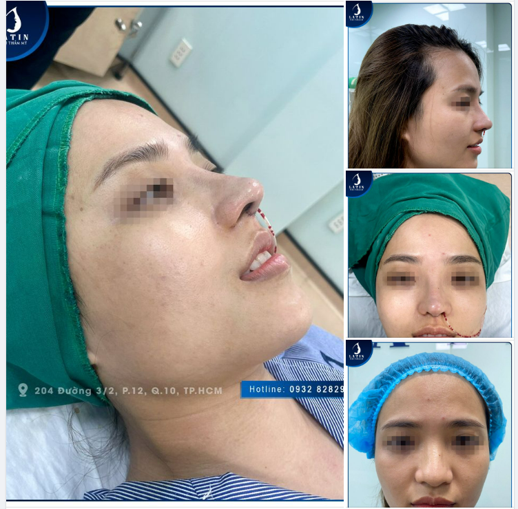 Một chiếc mũi đẹp tự nhiên cho bạn khách hàng dễ thương