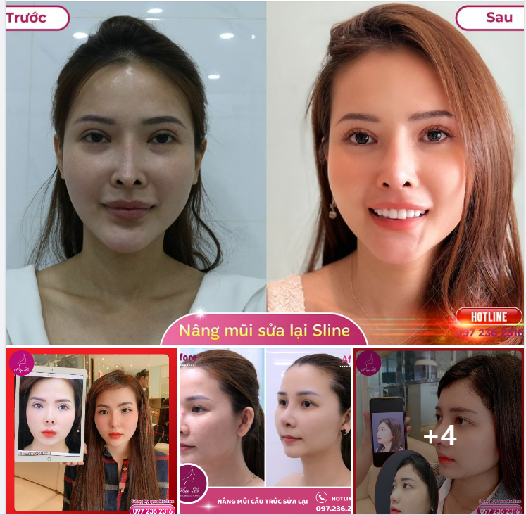 Bác sĩ Phan Hiệp Lợi - chuyên trị những ca mũi siêu khó