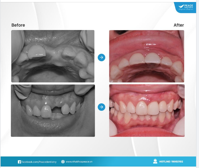  Mất răng nhiều năm, tiêu xương ổ răng, tụt (teo) nướu và kế hoạch điều trị thường được chỉ định