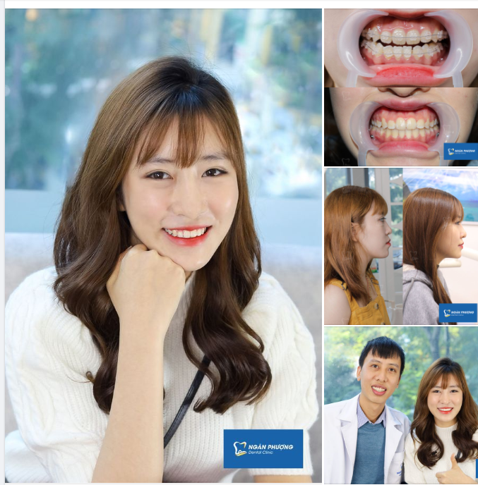 Tháo niềng đón Tết - Niềm vui này Nguyễn Lâm muốn lan toả tới tất cả đồng niềng