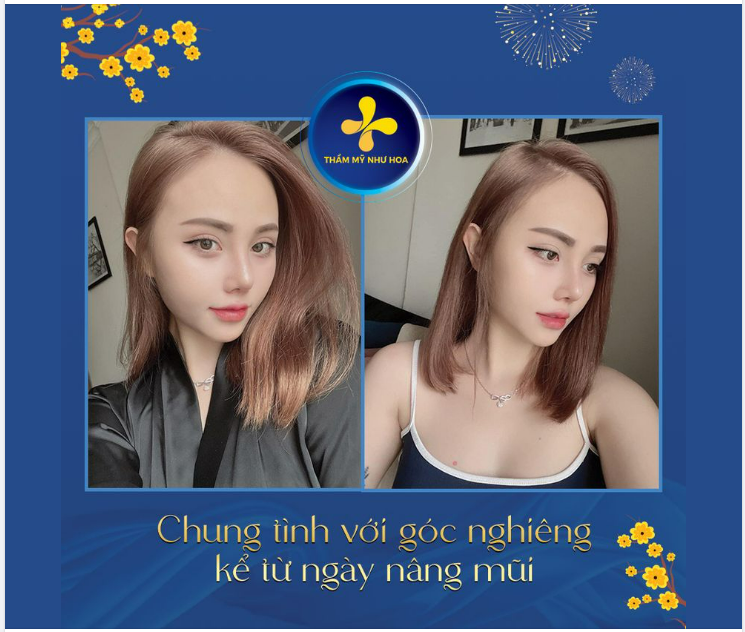 CHUNG TÌNH VỚI GÓC NGHIÊNG KỂ TỪ NGÀY NÂNG MŨI