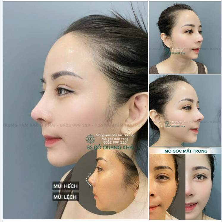 NÂNG MŨI CẤU TRÚC SỬA LẠI DÁNG MŨI BAY PHONG THỦY,