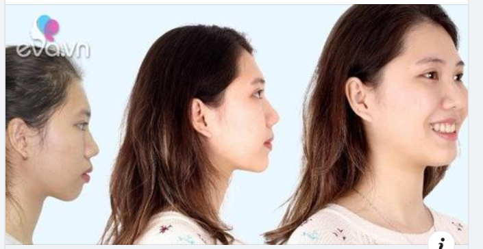 Ở Elite, bí quyết để từ góc nghiêng "vịt" bỗng "hóa thiên nga" mà không hề "d.a.o ke.ó" chính là: niềng răng với bác sĩ chỉnh nha tốt.