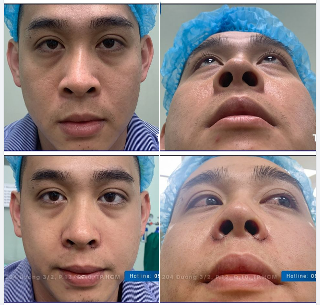 Cắt cuộn cánh mũi - giải pháp cho gương mặt hài hòa