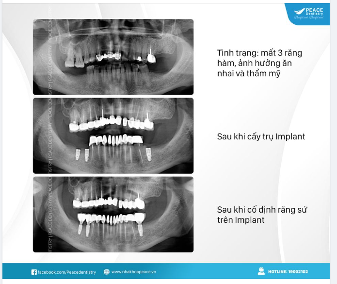 TRỒNG RĂNG IMPLANT - THÁCH THỨC VƯỢT THỜI GIAN