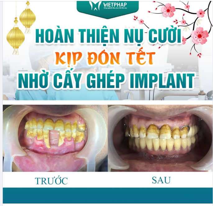 HOÀN THIỆN NỤ CƯỜI KỊP ĐÓN TẾT NHỜ CẤY GHÉP IMPLANT