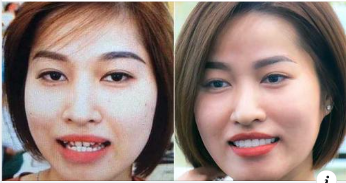 Răng mọc chen chúc phải làm thế nào?