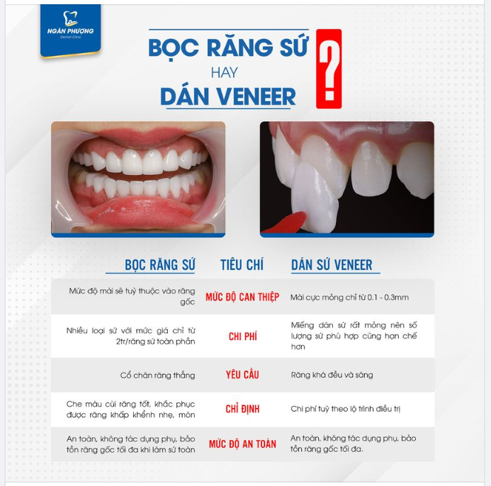 Bọc sứ hay dán sứ? Phân biệt thế nào, lợi hại ra sao?
