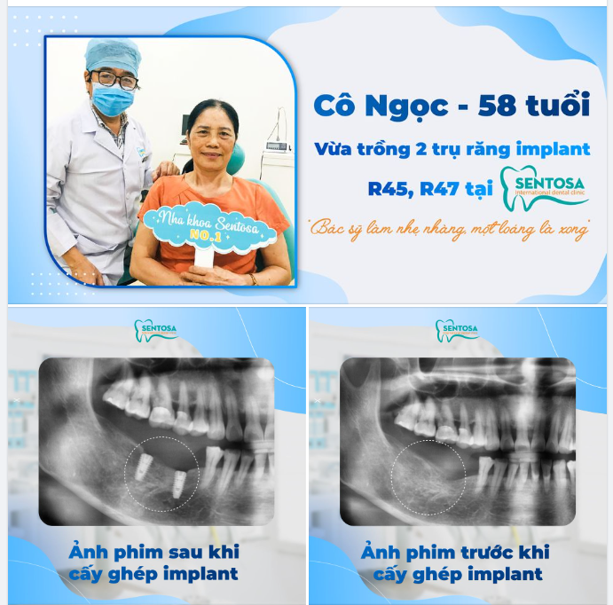 "TRỒNG 2 CHIẾC RĂNG IMPLANT CHỈ 1 LOÁNG LÀ XONG"