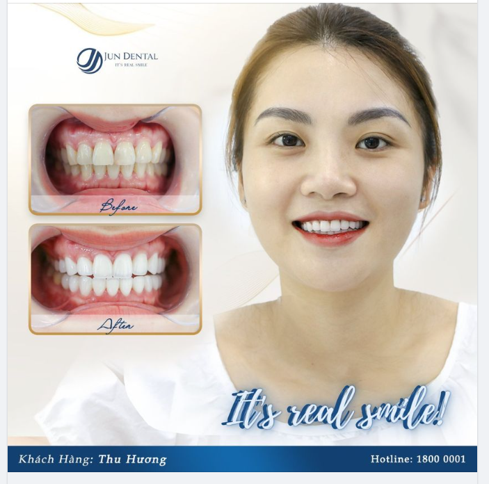 RĂNG SỨ HT SMILE - NỤ CƯỜI TƯƠI SÁNG, TRONG VEO HOÀN HẢO
