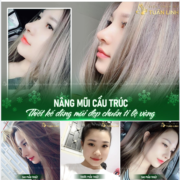 Dáng mũi cao bay - Thanh tú - Tự nhiên - Chuẩn tỉ lệ vàng.Được thiết kế riêng theo từng đường nét khuôn mặt.