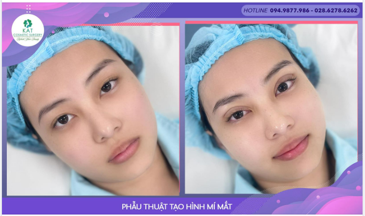 Vì sao nhiều chị em mắt hai mí vẫn tìm đến KAT để tạo hình mí mắt