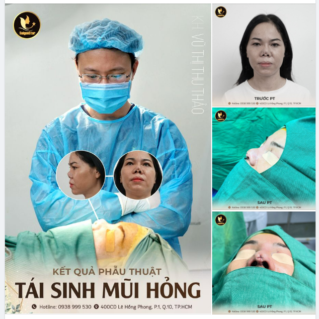 KẾT QUẢ CA PHẪU THUẬT TÁI SINH MŨI HỎNG