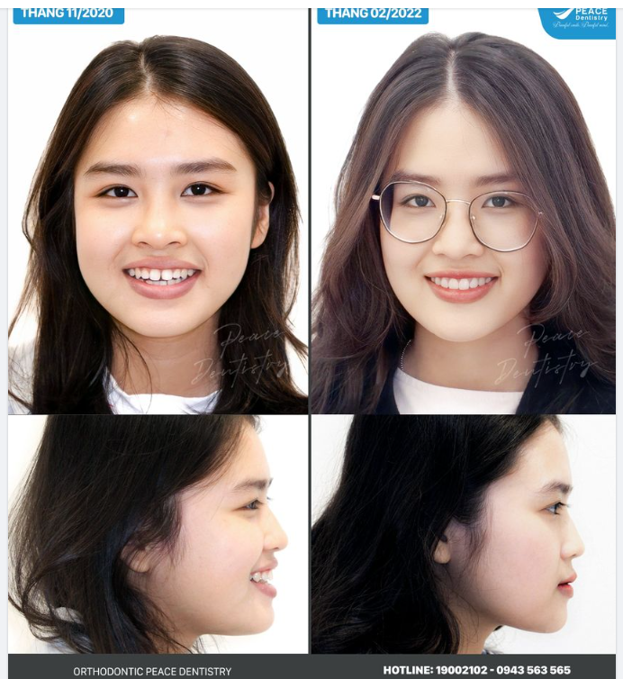 KHI BẠN NIỀNG RĂNG TẠI NHA KHOA UY TÍN, BÁC SĨ GIỎI