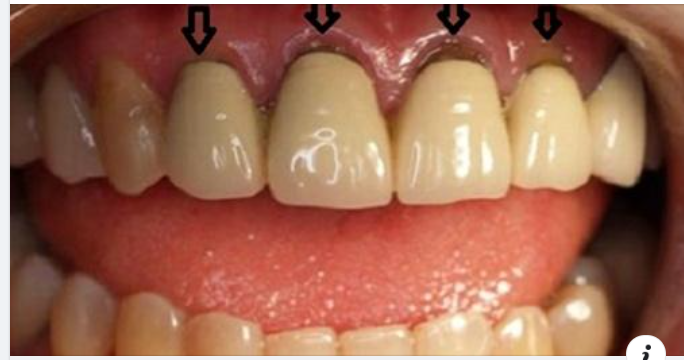TẠI SAO LÀM RĂNG SỨ XONG LẠI BỊ HỞ CHÂN RĂNG?