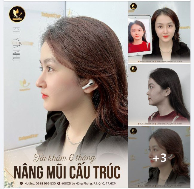 TÁI KHÁM 6 THÁNG NÂNG MŨI CẤU TRÚC