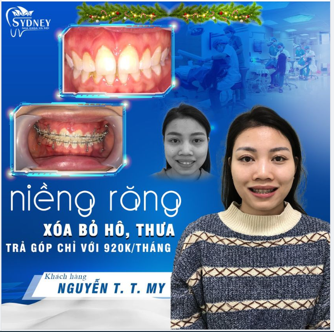 Thay đổi rõ rệt khi vẫn đang trong quá trình niềng răng