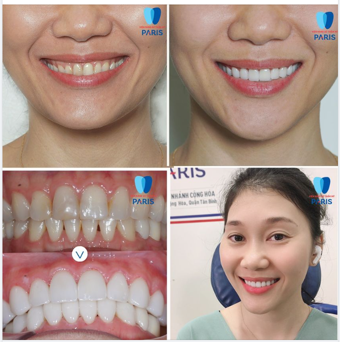 SIÊU PHẨM DÁN SỨ VENEER KHÔNG MÀI RĂNG TẠI NHA KHOA PARIS