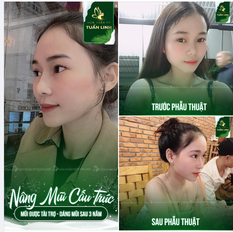NÂNG MŨI CAO XINH - BỀN ĐẸP DÀI LÂU Chọn ngay Tuấn Linh nha!!