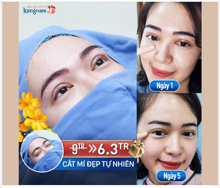 Cắt mí bây giờ - Sợ không kịp Tết???