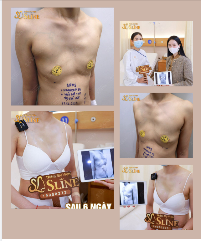 XÓA TAN NỖI LO VỀ NGỰC PHẲNG.