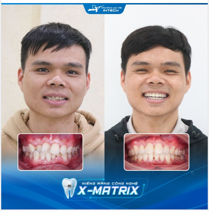 NIỀNG RĂNG CÔNG NGHỆ X-MATRIX - PHÙ HỢP VỚI MỌI LỨA TUỔI