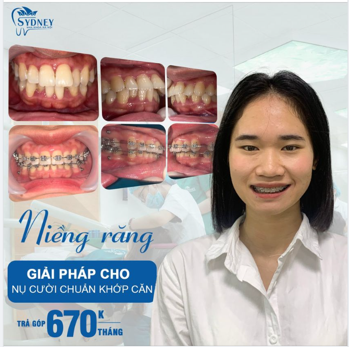 Niềng răng hô – Giải pháp cho nụ cười chuẩn khớp cắn
