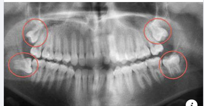 NHỮNG BIẾN CHỨNG DO RĂNG KHÔN MỌC LỆCH VÀ CÁCH XỬ TRÍ