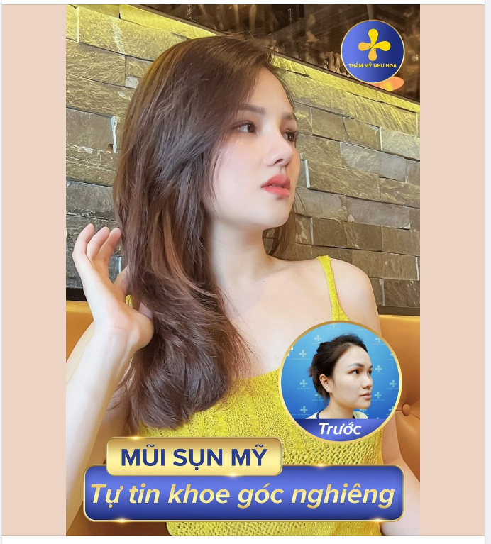 Nâng mũi thay đổi khuôn mặt, thần thái của một người!