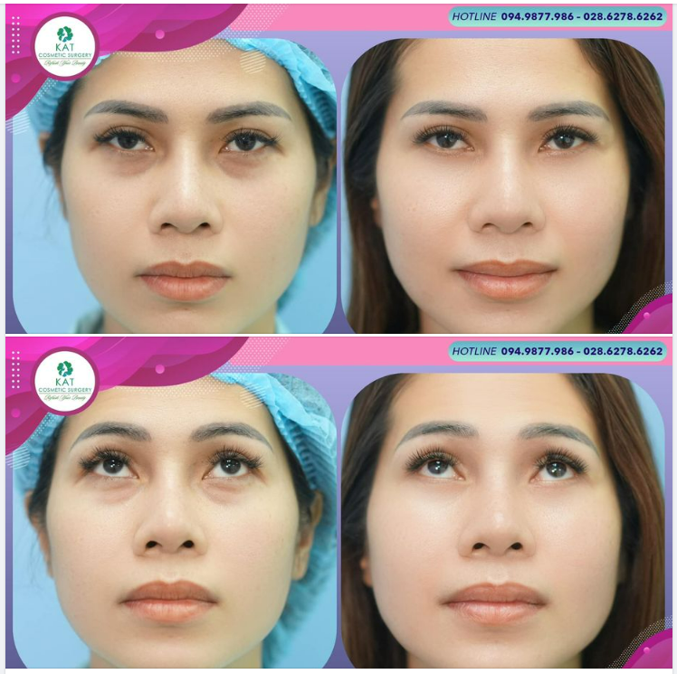 Cùng KAT gác lại hết âu lo bằng cách xoá tan bọng mắt dưới nhé