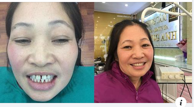 Lớn tuổi niềng răng được không?