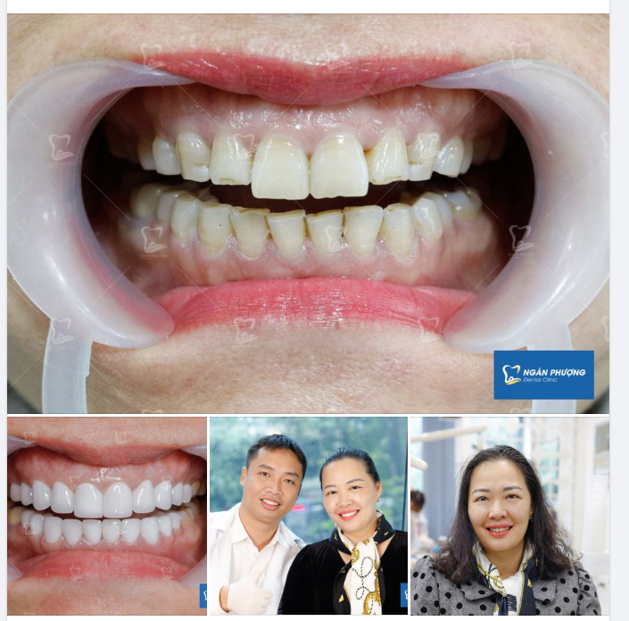 Theo thời gian, răng có thể xuống màu, tụt lợi sinh lý, mòn men,