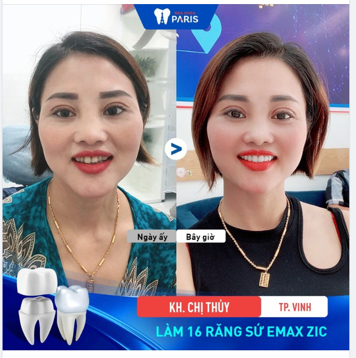 Biến hình nhanh chóng cho hàm răng nhiễm màu, sứt mẻ