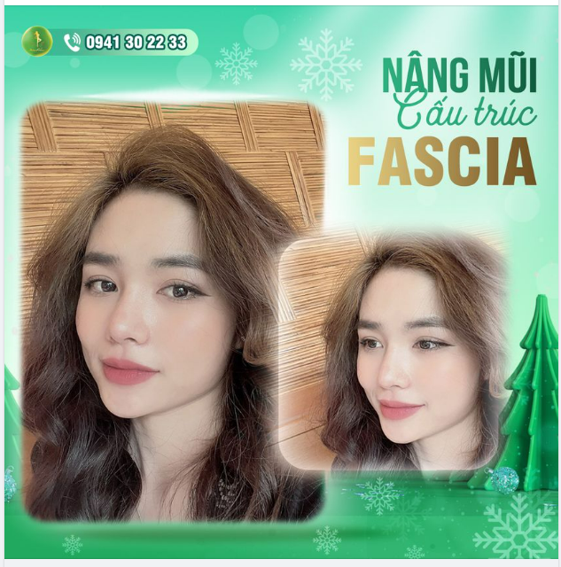 MŨI CẤU TRÚC FASCIA - THẢ GA NHẬN ƯU ĐÃI