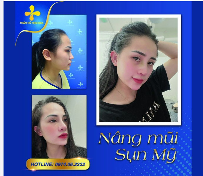 Cận cảnh góc nghiêng của khách hàng trước và sau khi nâng mũi sụn mỹ.