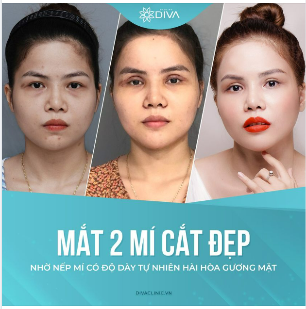 MẮT 2 MÍ CẮT ĐẸP NHỜ NẾP MÍ CÓ ĐỘ DÀY TỰ NHIÊN HÀI HÒA GƯƠNG MẶT