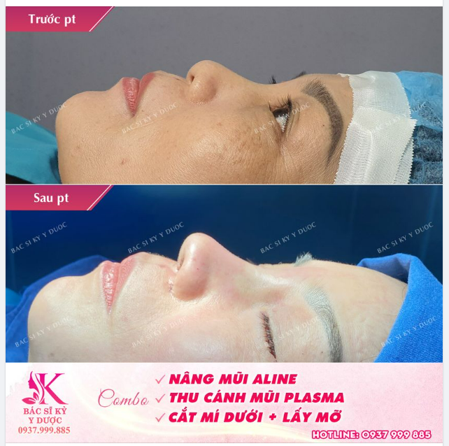 COMBO Nâng mũi ALINE - Thu cánh mũi - Cắt mí dưới lấy mỡ