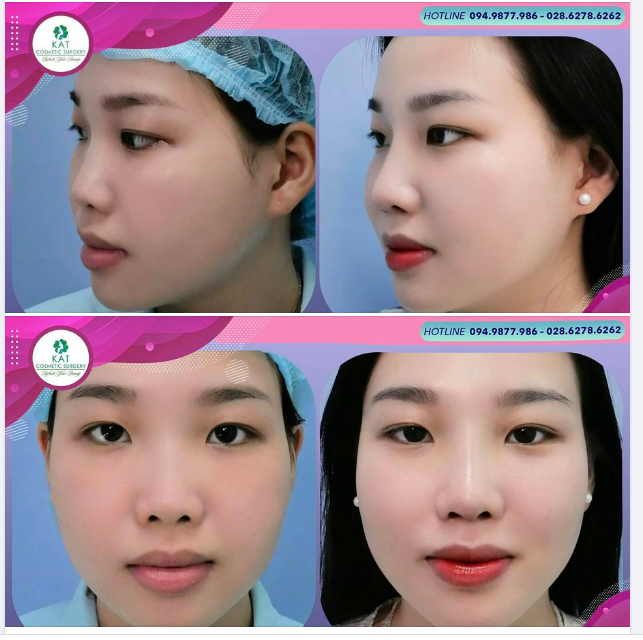 Sau phẫu thuật nâng mũi bọc sụn tự thân chiếc mũi bị hếch và thấp góc đã được thay đổi hoàn toàn bởi một dáng mũi cao thanh thoát nhưng vẫn giữ được sự tự nhiên nhất cho gương mặt .