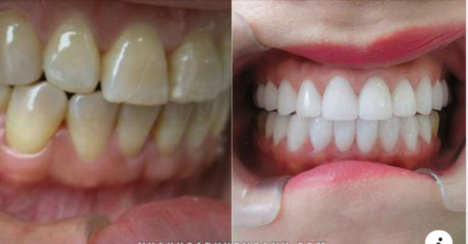 Bọc răng sứ thẩm mỹ là gì? có tốt không? có đau không?