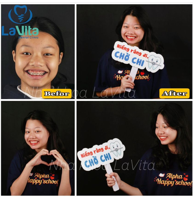 Hoàn thiện ca niềng răng mắc cài cho bạn khách hàng của Nha khoa Lavita.