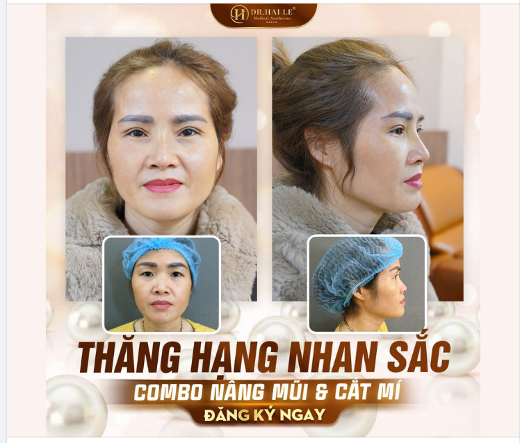 COMBO NÂNG MŨI CẮT MÍ TẠI DR.HẢI LÊ - ĐẸP TỰ NHIÊN SAU 10 NGÀY