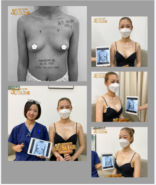NÂNG NGỰC NANOCHIPEG Sau 1 năm