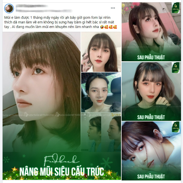 ĐẸP NỔI BẬT VỚI DÁNG MŨI CAO THANH TÚ!