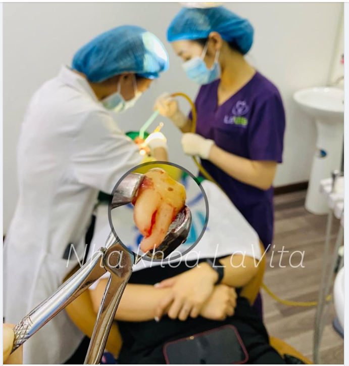 Phương pháp này đặc biệt an toàn cho răng, nhẹ nhàng, hạn chế tối đa sưng đau.