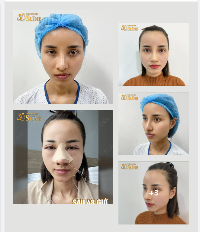 S.O.S CẤP CỨU “SẢN PHẪM” MŨI - MÍ LỖI CỦA SPA !