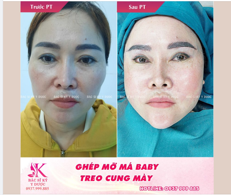 Combo lấy lại tuổi thanh xuân
