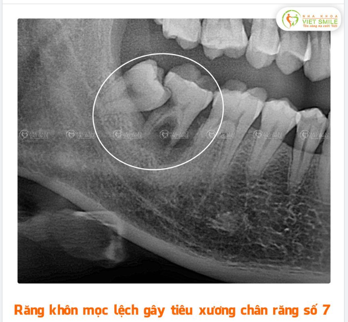 Răng khôn đâm vào răng số 7: Nguyên nhân, hậu quả và cách điều trị hiệu quả